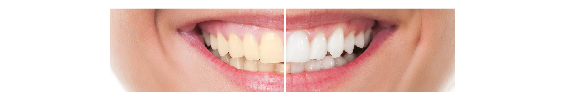 Whitening